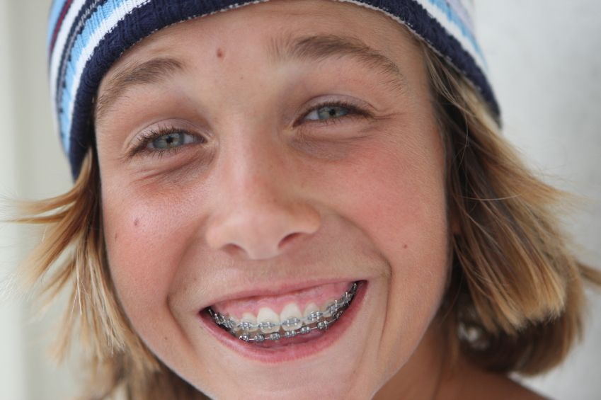 bracing your kids for braces